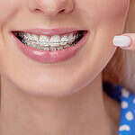 Invisible Braces