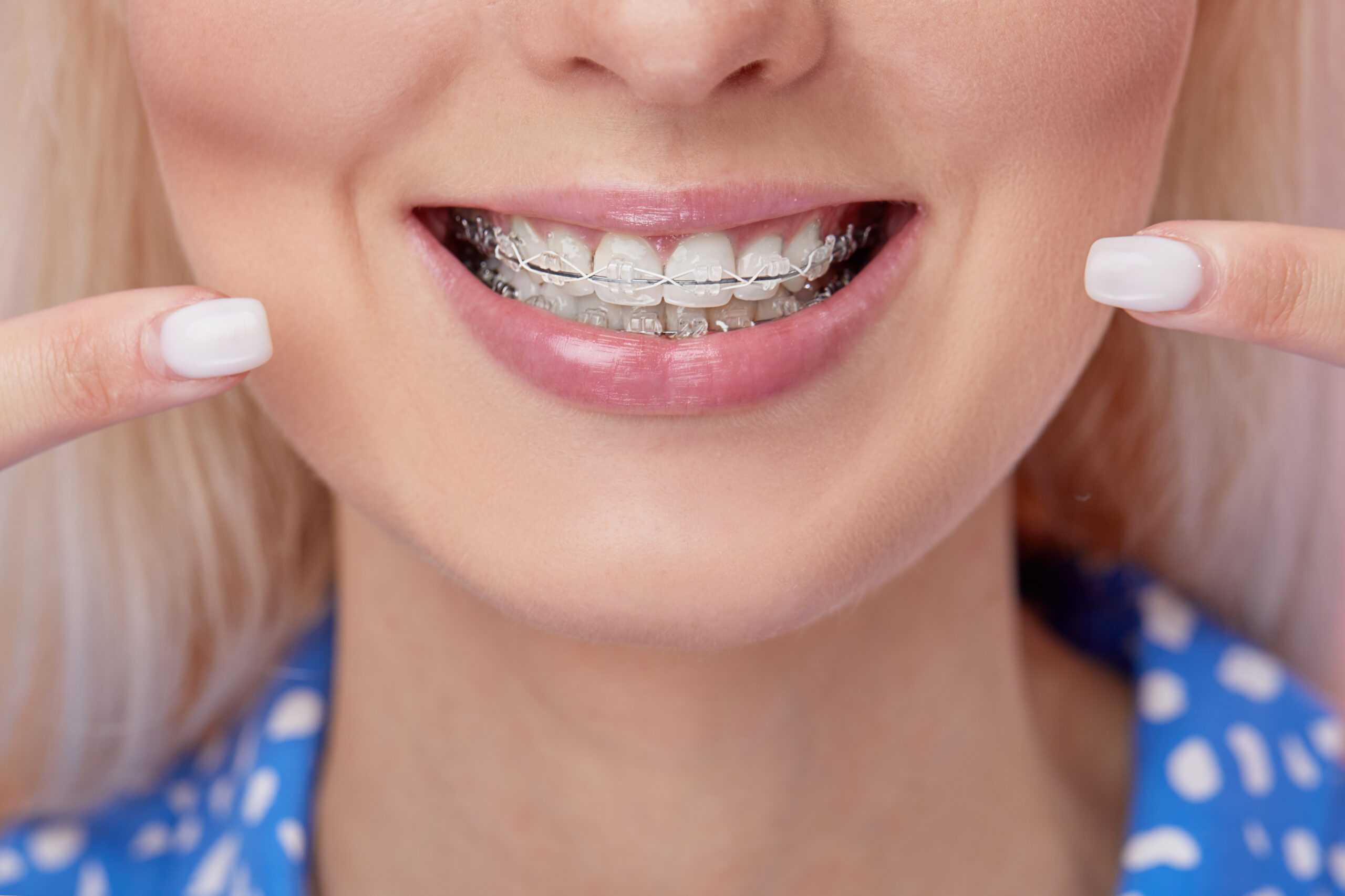 Invisible Braces